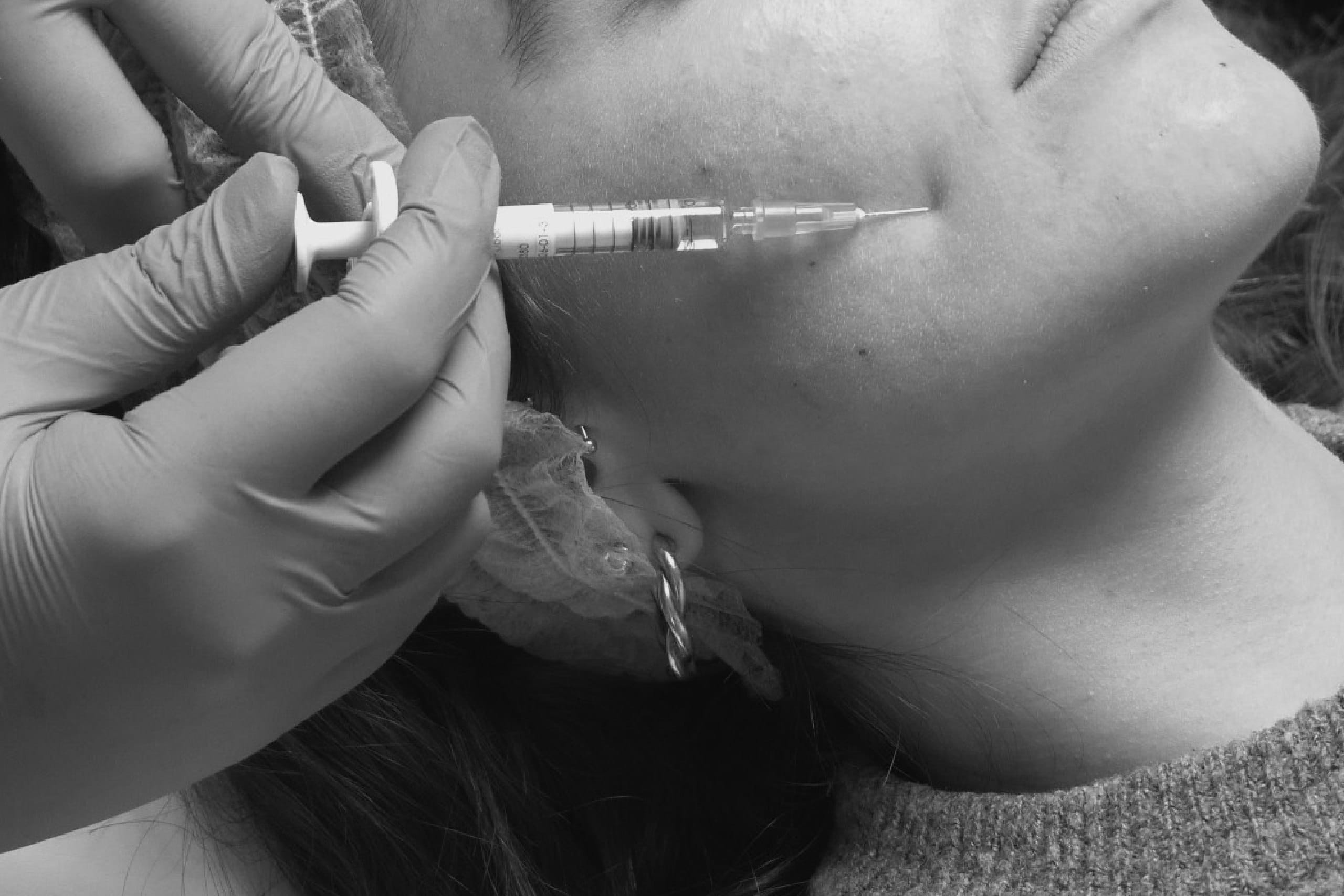 Inductores de Colágeno · IRE A. Medicina Estética