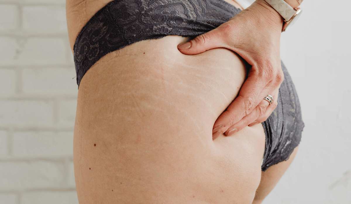 Estrías en los glúteos