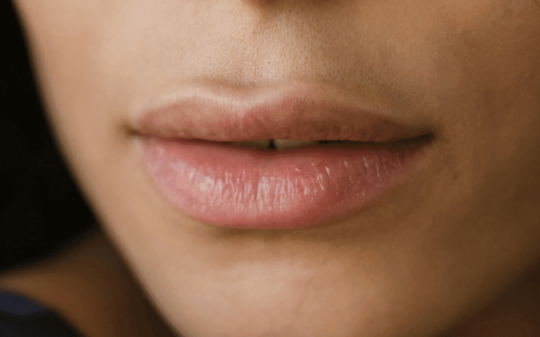 Perfilado de labios: antes y después